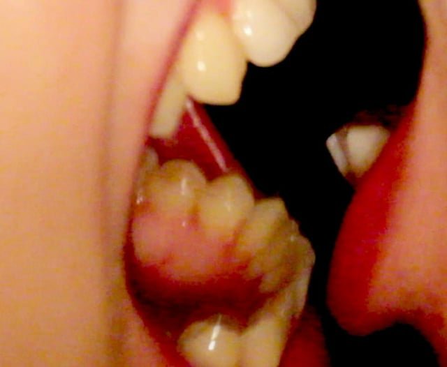 Teeth(Basium VIII)